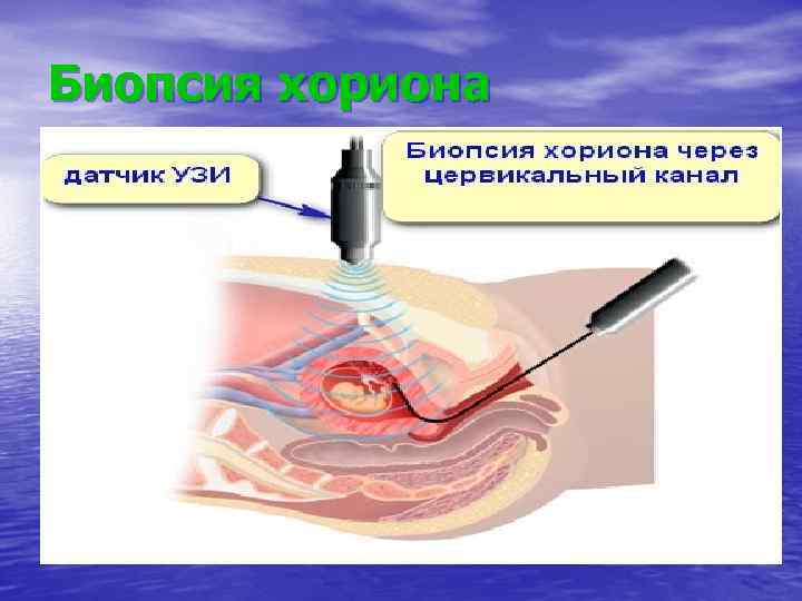 Биопсия хориона 