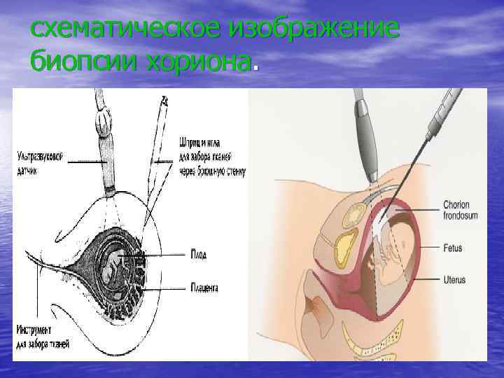 схематическое изображение биопсии хориона. 