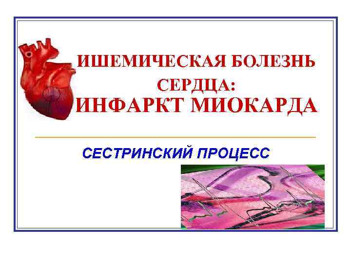 ИШЕМИЧЕСКАЯ БОЛЕЗНЬ СЕРДЦА: ИНФАРКТ МИОКАРДА СЕСТРИНСКИЙ ПРОЦЕСС 