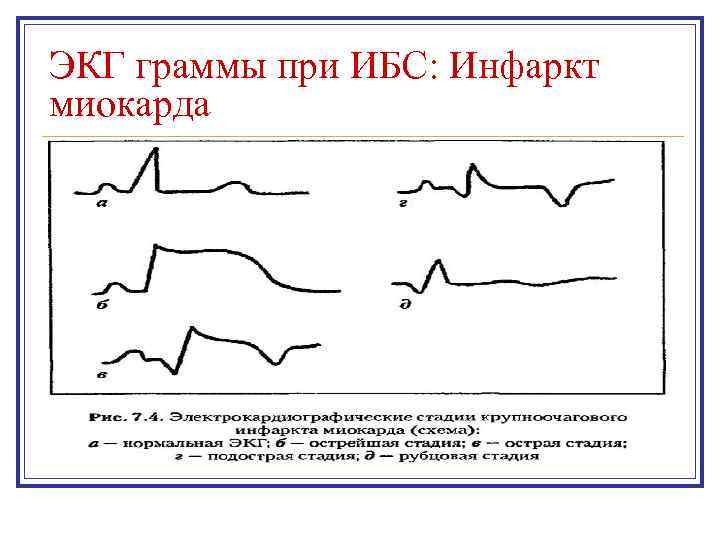 ЭКГ граммы при ИБС: Инфаркт миокарда 