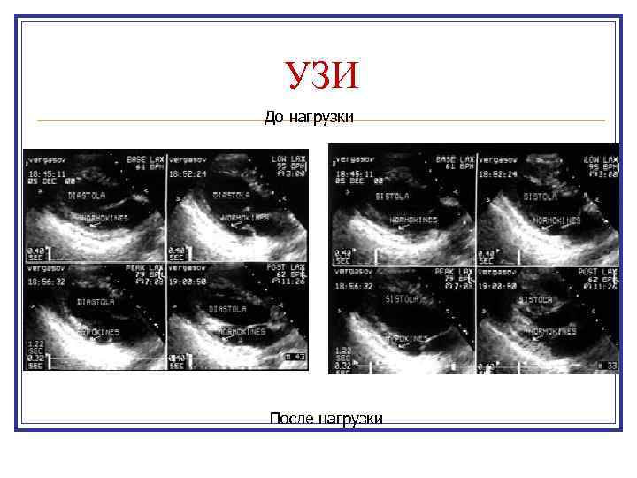 УЗИ До нагрузки После нагрузки 