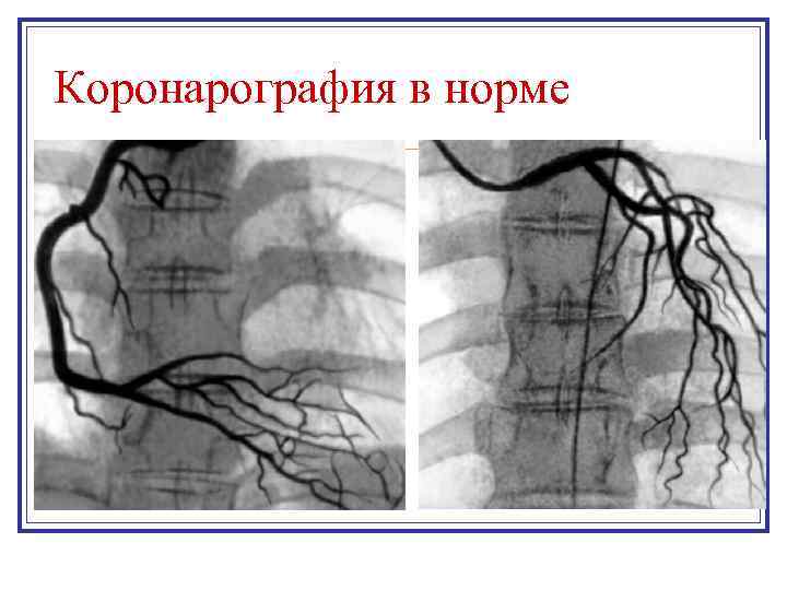 Коронарография в норме 