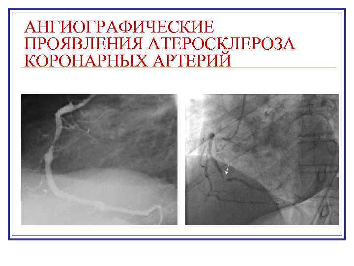 АНГИОГРАФИЧЕСКИЕ ПРОЯВЛЕНИЯ АТЕРОСКЛЕРОЗА КОРОНАРНЫХ АРТЕРИЙ 