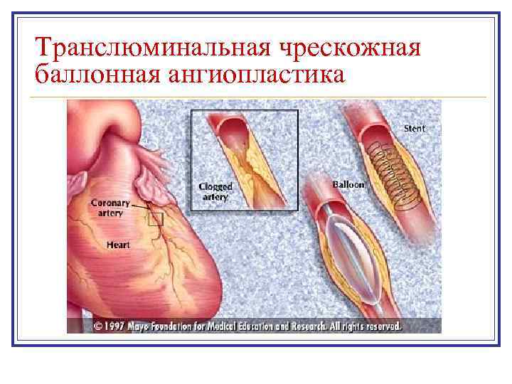 Транслюминальная чрескожная баллонная ангиопластика 