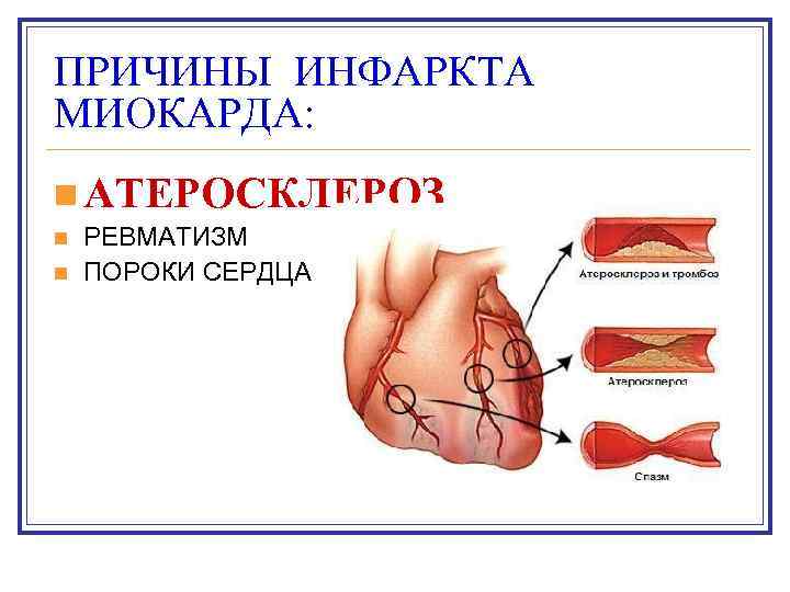 ПРИЧИНЫ ИНФАРКТА МИОКАРДА: n АТЕРОСКЛЕРОЗ n n РЕВМАТИЗМ ПОРОКИ СЕРДЦА 