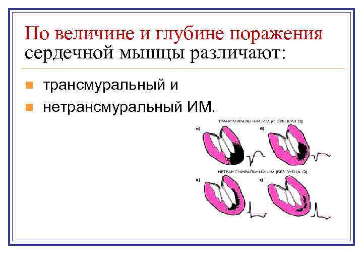 По величине и глубине поражения сердечной мышцы различают: трансмуральный и n нетрансмуральный ИМ. n