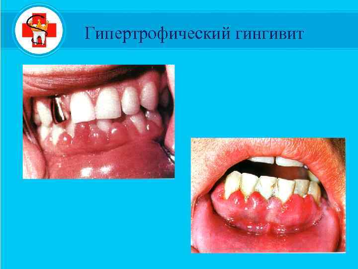 Гипертрофический гингивит 