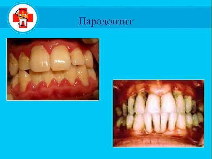  Пародонтит 