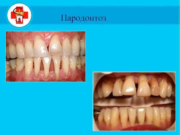 Пародонтоз 