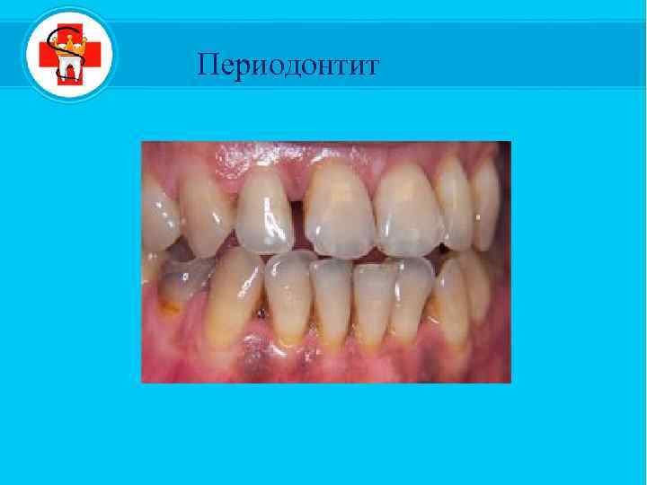  Периодонтит 