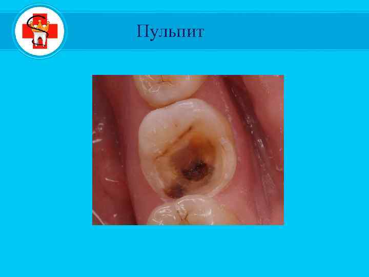 Пульпит 
