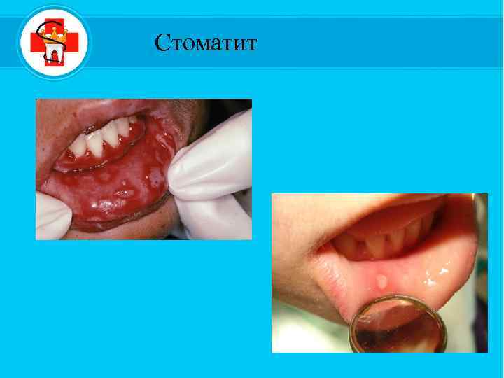 Стоматит 