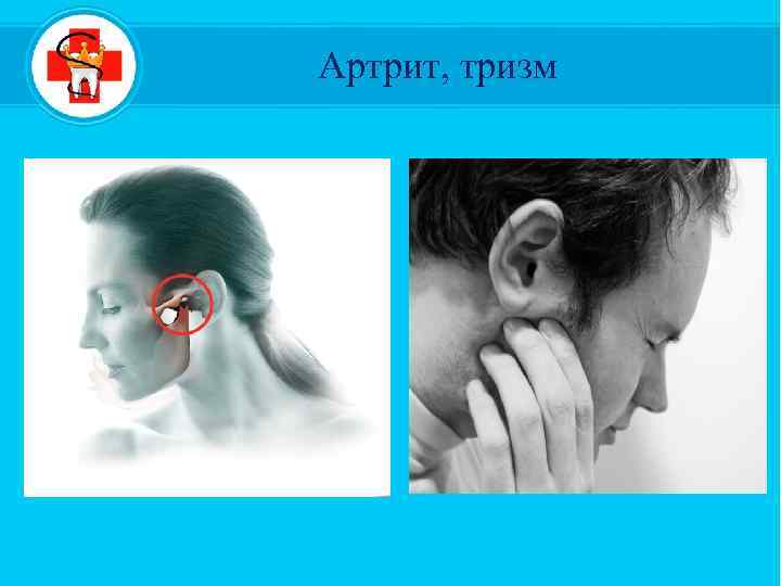  Артрит, тризм 