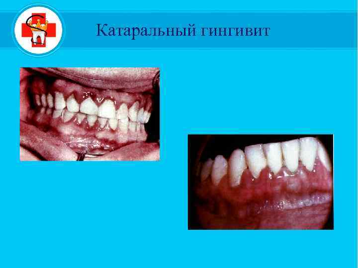 Катаральный гингивит 