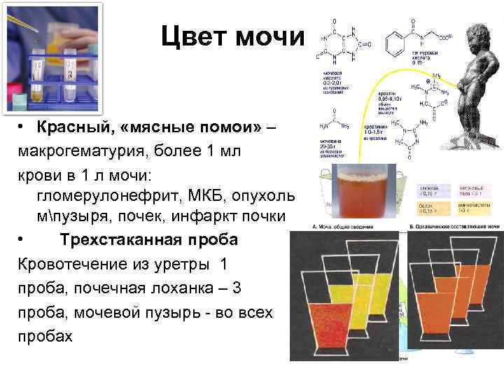 Цвет мочи • Красный, «мясные помои» – макрогематурия, более 1 мл крови в 1