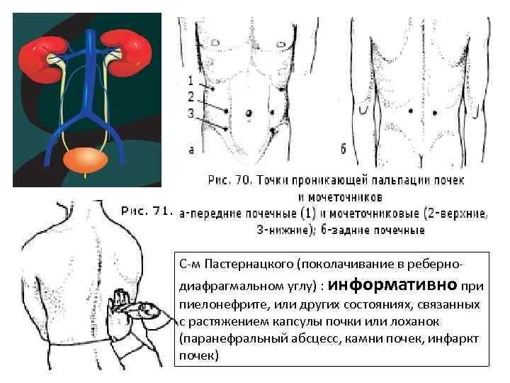 С-м Пастернацкого (поколачивание в реберно- диафрагмальном углу) : информативно при пиелонефрите, или других состояниях,