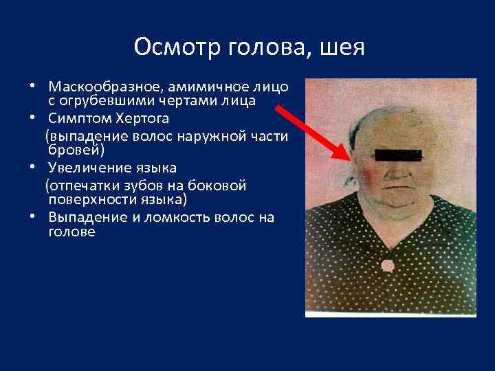 Осмотр голова, шея • Маскообразное, амимичное лицо с огрубевшими чертами лица • Симптом Хертога