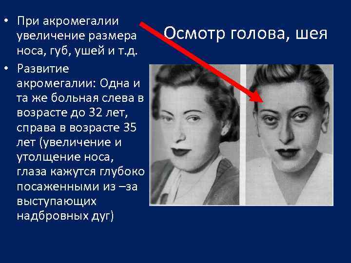  • При акромегалии увеличение размера носа, губ, ушей и т. д. • Развитие