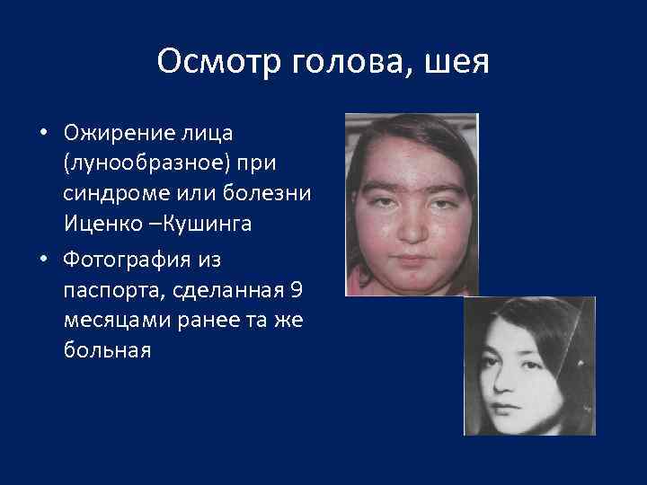 Осмотр голова, шея • Ожирение лица (лунообразное) при синдроме или болезни Иценко –Кушинга •