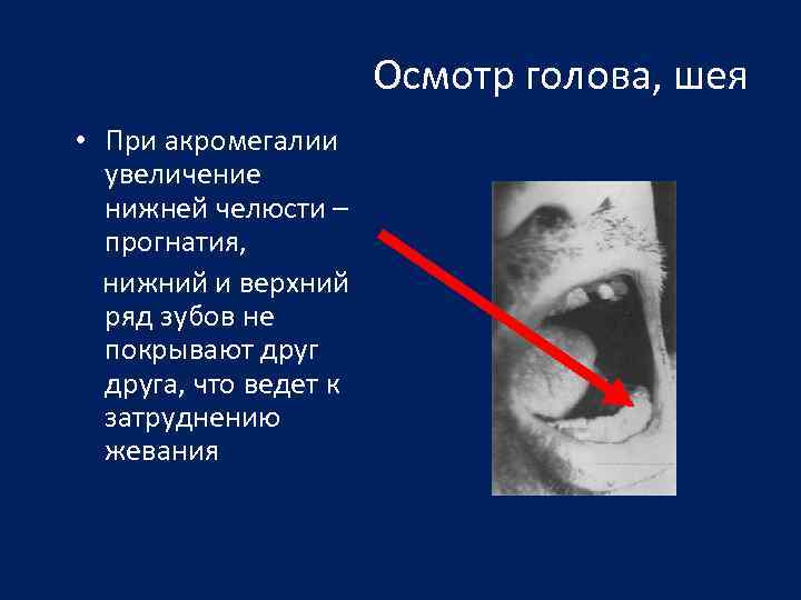 Осмотр голова, шея • При акромегалии увеличение нижней челюсти – прогнатия, нижний и верхний