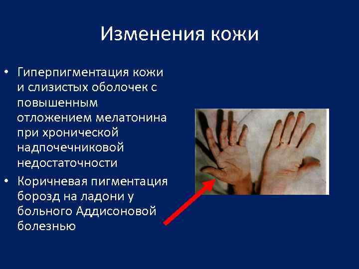 Изменения кожи • Гиперпигментация кожи и слизистых оболочек с повышенным отложением мелатонина при хронической