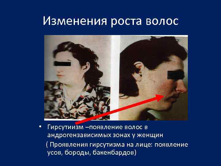 Изменения роста волос • Гирсутиизм –появление волос в андрогензависимых зонах у женщин ( Проявления