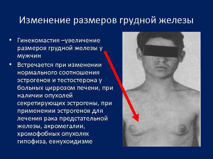 Изменение размеров грудной железы • Гинекомастия –увеличение размеров грудной железы у мужчин • Встречается