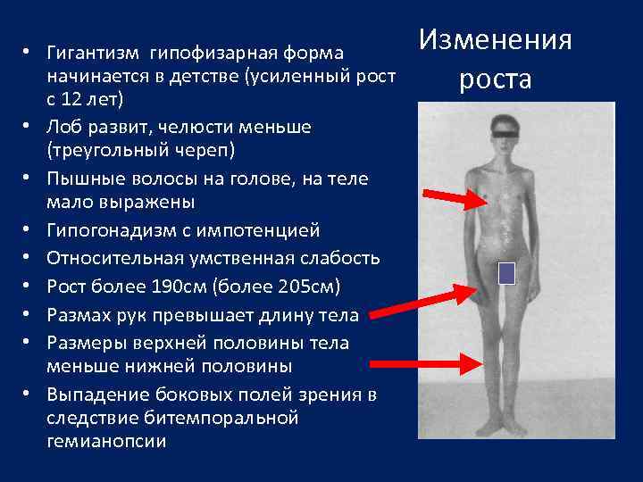  • Гигантизм гипофизарная форма начинается в детстве (усиленный рост с 12 лет) •