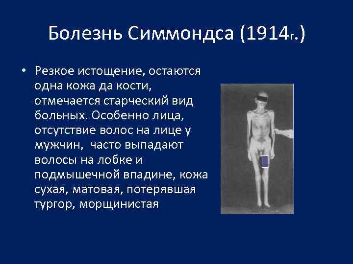Болезнь Симмондса (1914 г. ) • Резкое истощение, остаются одна кожа да кости, отмечается