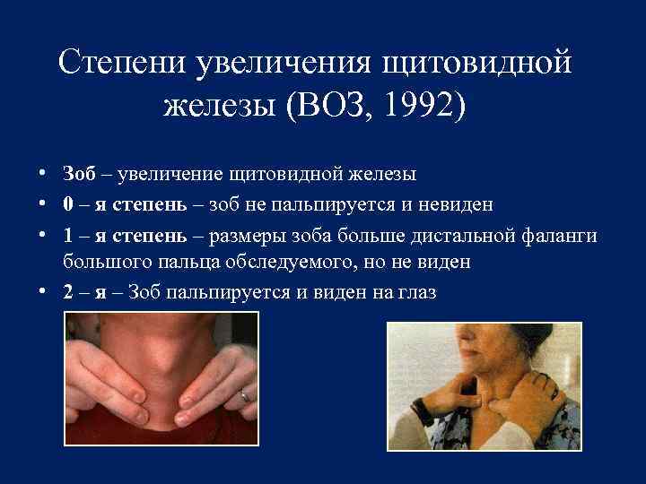 Степени увеличения щитовидной железы (ВОЗ, 1992) • Зоб – увеличение щитовидной железы • 0