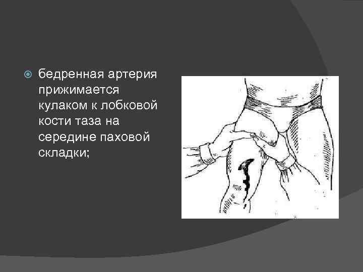  бедренная артерия прижимается кулаком к лобковой кости таза на середине паховой складки; 