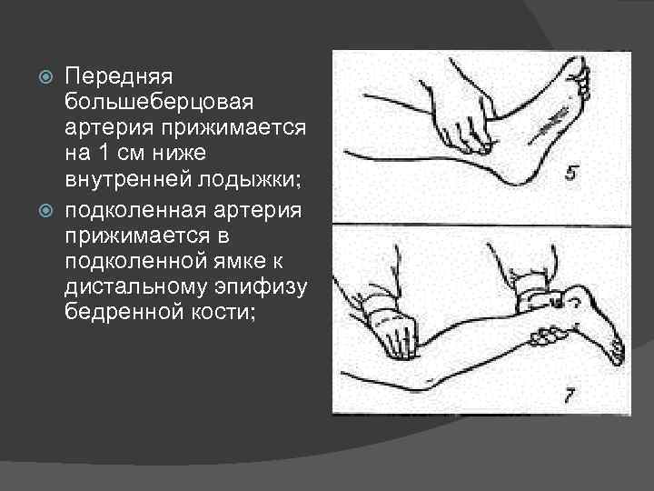 Передняя большеберцовая артерия прижимается на 1 см ниже внутренней лодыжки; подколенная артерия прижимается в
