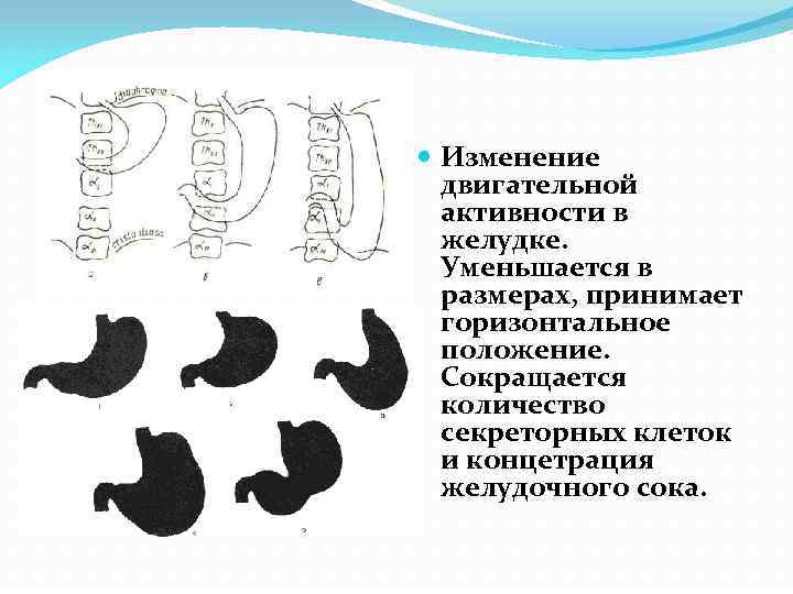  Изменение двигательной активности в желудке. Уменьшается в размерах, принимает горизонтальное положение. Сокращается количество