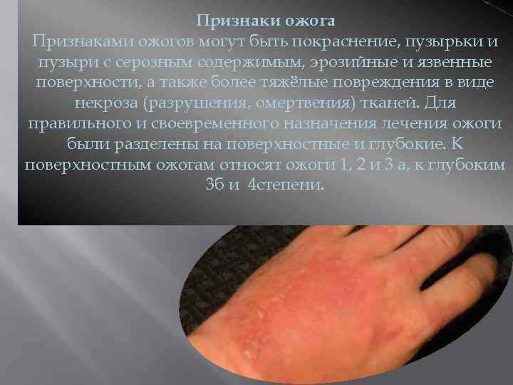 Признаки ожога Признаками ожогов могут быть покраснение, пузырьки и пузыри с серозным содержимым, эрозийные