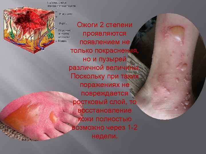 Ожоги 2 степени проявляются появлением не только покраснения, но и пузырей различной величины. Поскольку