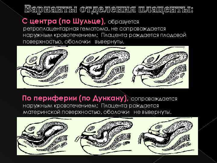 Варианты отделения плаценты: С центра (по Шульце), образуется ретроплацентарная гематома, не сопровождается наружным кровотечением;