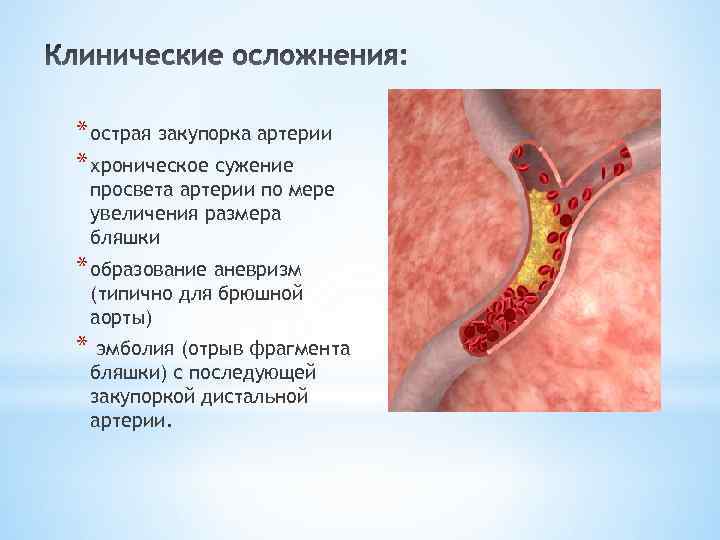 * острая закупорка артерии * хроническое сужение просвета артерии по мере увеличения размера бляшки