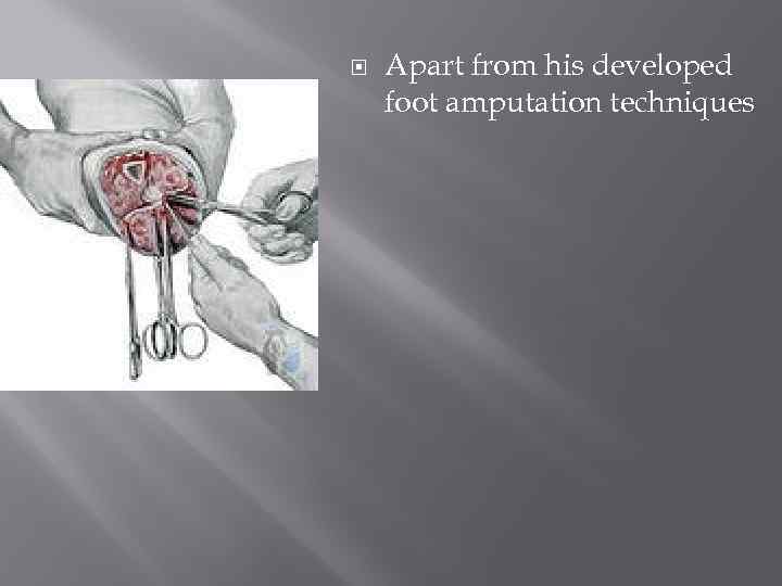  Apart from his developed foot amputation techniques 