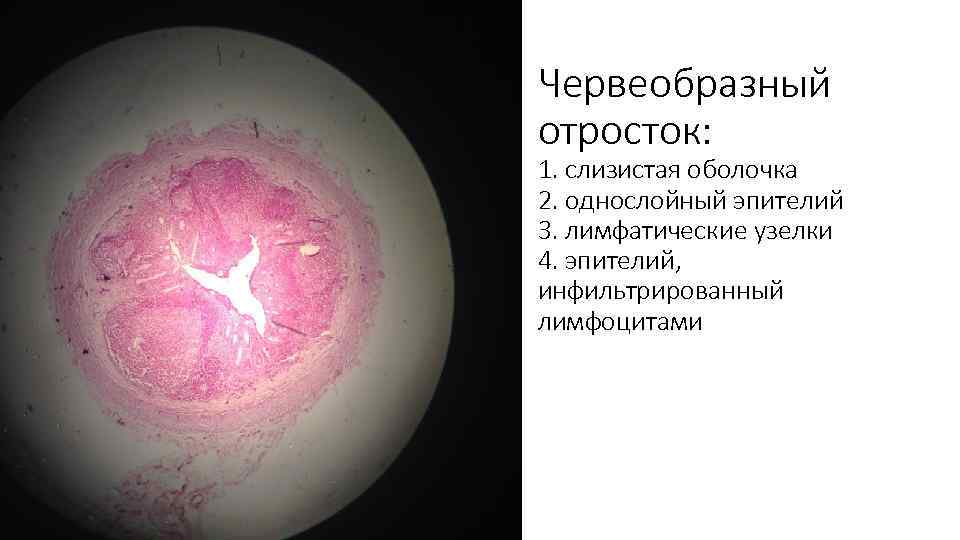 Червеобразный отросток: 1. слизистая оболочка 2. однослойный эпителий 3. лимфатические узелки 4. эпителий, инфильтрированный