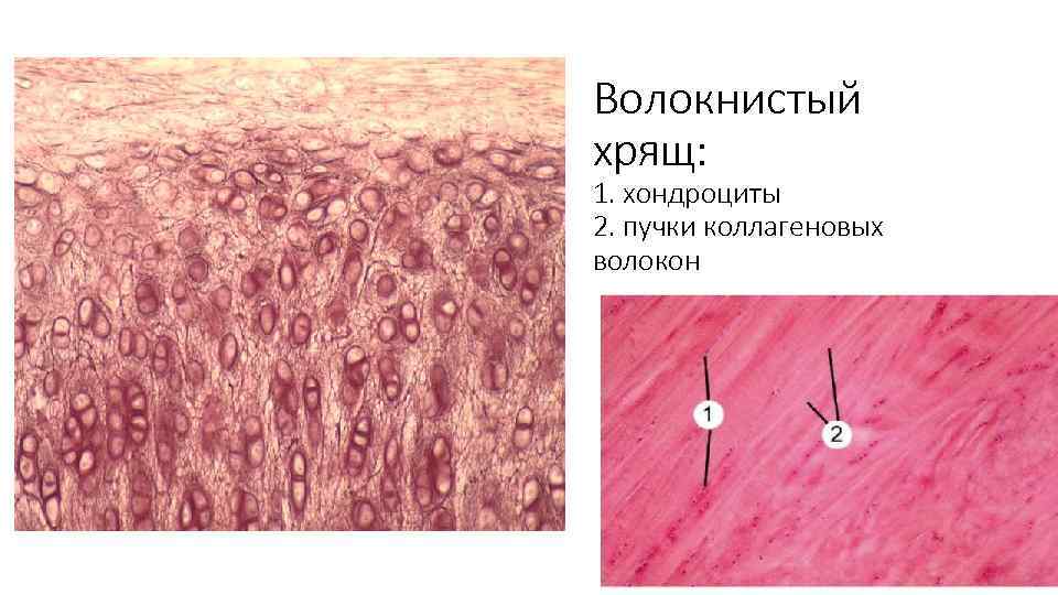 Волокнистый хрящ: 1. хондроциты 2. пучки коллагеновых волокон 