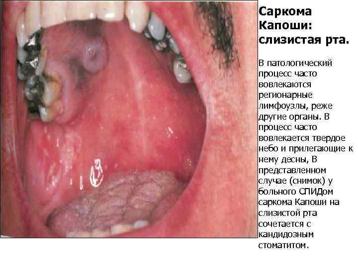 Саркома Капоши: слизистая рта. В патологический процесс часто вовлекаются регионарные лимфоузлы, реже другие органы.