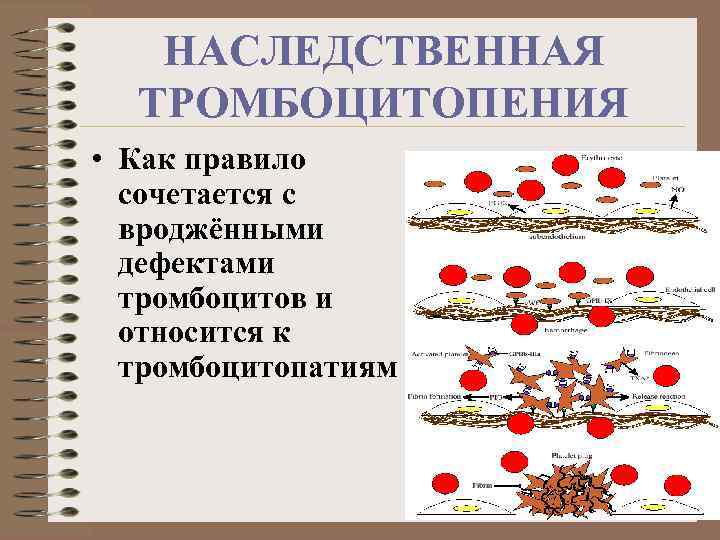 НАСЛЕДСТВЕННАЯ ТРОМБОЦИТОПЕНИЯ • Как правило сочетается с вроджёнными дефектами тромбоцитов и относится к тромбоцитопатиям