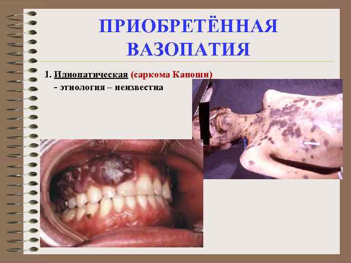 ПРИОБРЕТЁННАЯ ВАЗОПАТИЯ 1. Идиопатическая (саркома Капоши) - этиология – неизвестна 