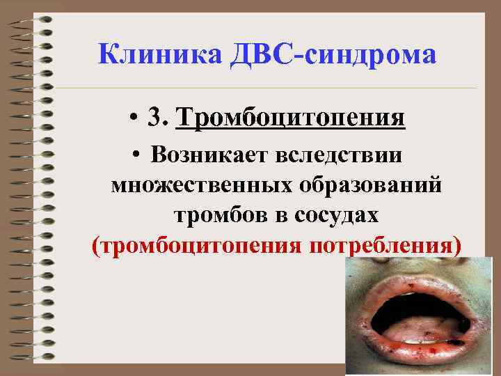 Клиника ДВС-синдрома • 3. Тромбоцитопения • Возникает вследствии множественных образований тромбов в сосудах (тромбоцитопения