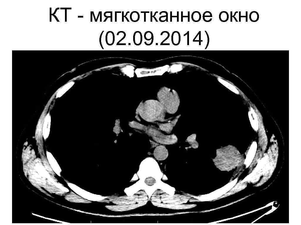Мягкотканное образование в легком на кт