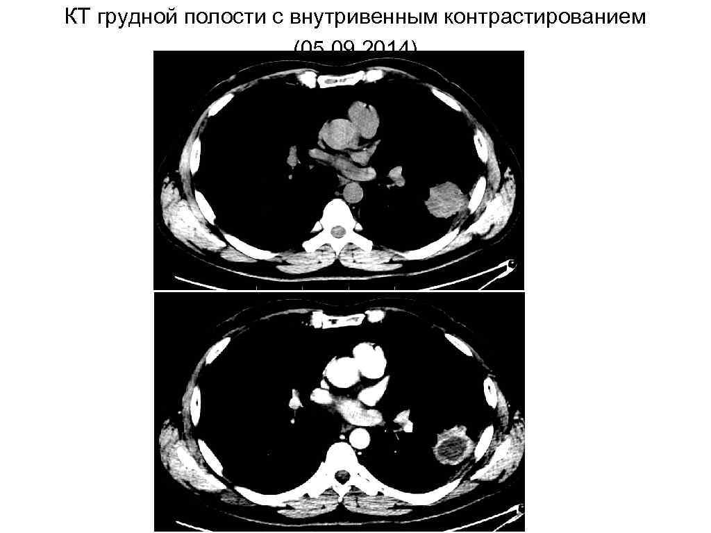 КТ грудной полости с внутривенным контрастированием (05. 09. 2014) 