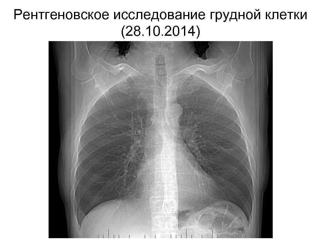 Рентгеновское исследование грудной клетки (28. 10. 2014) 