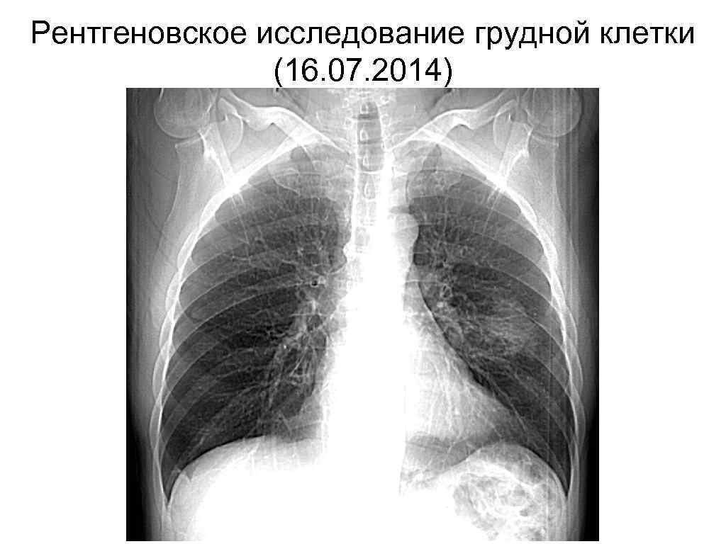 Рентгеновское исследование грудной клетки (16. 07. 2014) 