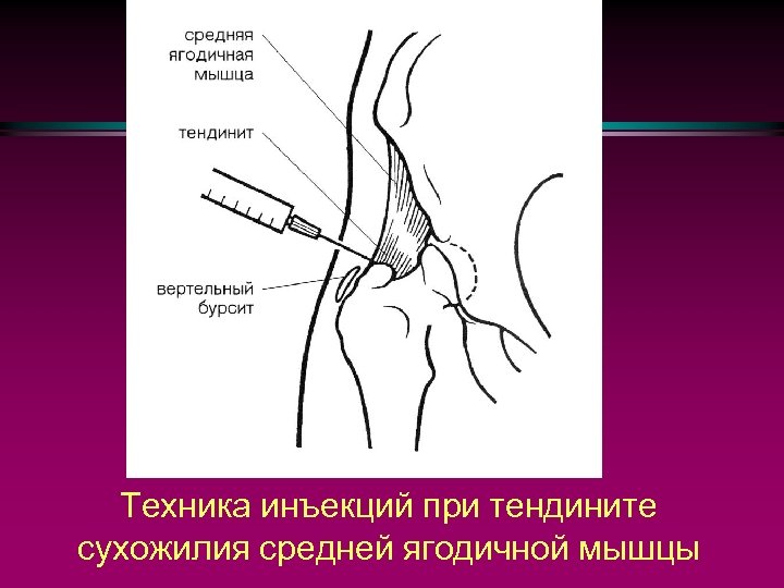 Что такое тендиноз тазобедренного сустава