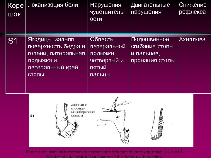 Коре Локализация боли шок S 1 Ягодицы, задняя поверхность бедра и голени, латеральная лодыжка